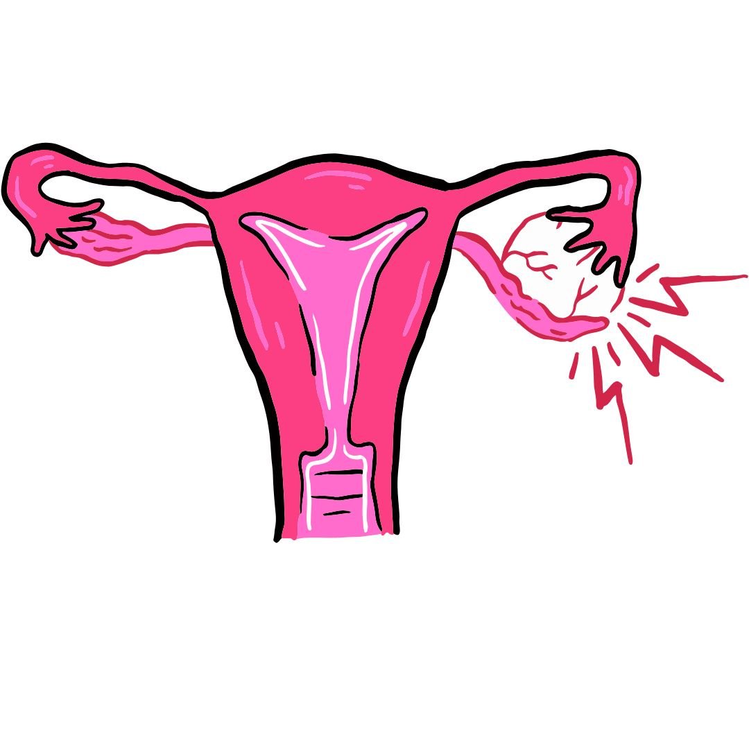 How to Get Pregnant with PCOD Naturally